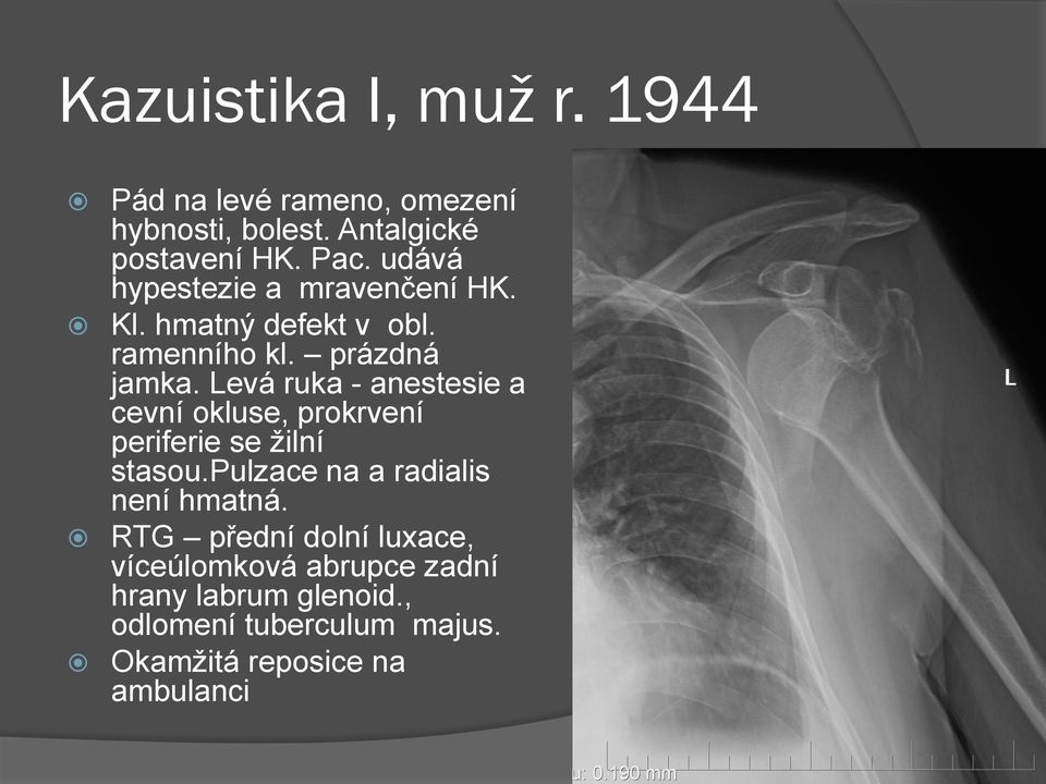 Levá ruka - anestesie a cevní okluse, prokrvení periferie se žilní stasou.pulzace na a radialis není hmatná.