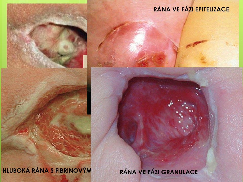 HLUBOKÁ RÁNA S FIBRINOVÝM