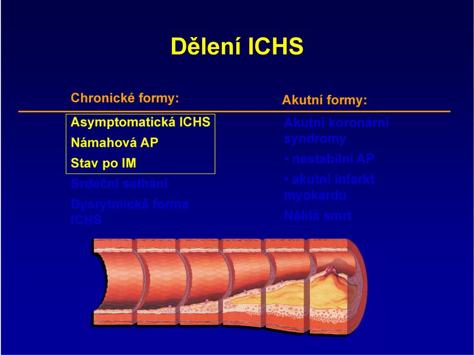 Dysrytmická forma ICHS Akutní formy: Akutní