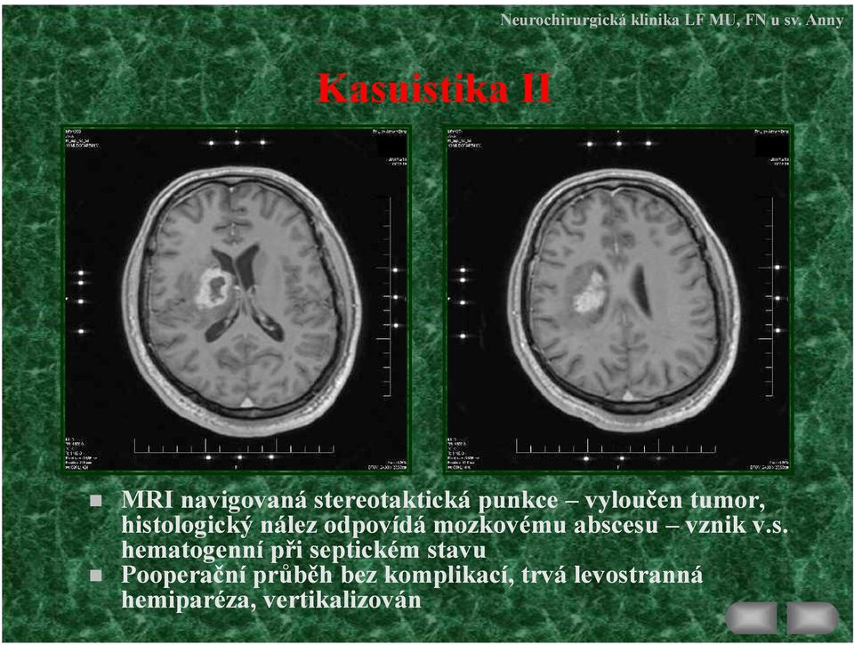 abscesu vznik v.s. hematogenní při septickém stavu