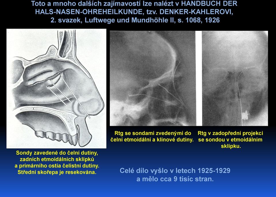 1068, 1926 Sondy zavedené do čelní dutiny, zadních etmoidálních sklípků a primárního ostia čelistní dutiny.