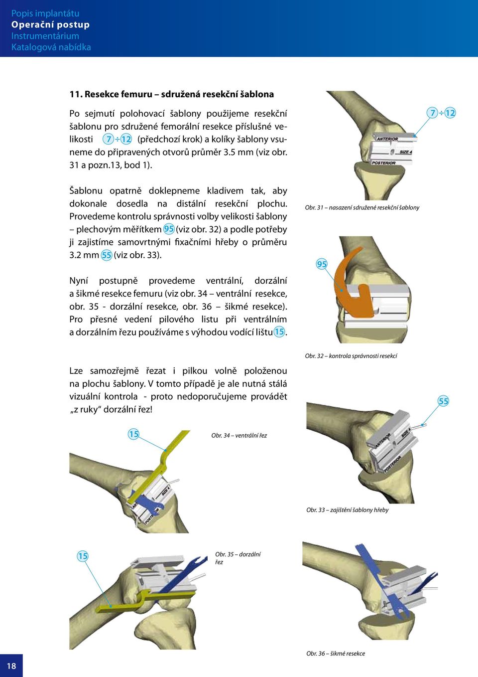 připravených otvorů průměr 3.5 mm (viz obr. 3 a pozn.3, bod ). 7 Šablonu opatrně doklepneme kladivem tak, aby dokonale dosedla na distální resekční plochu.