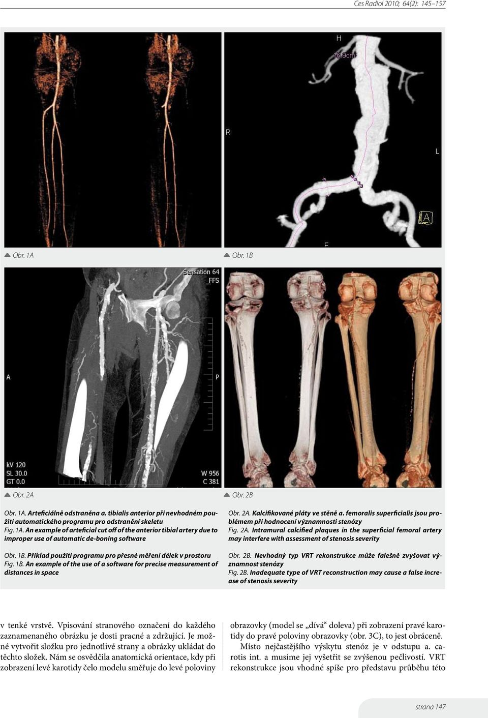 femoralis superficialis jsou problémem při hodnocení významnosti stenózy Fig. 2A. Intramural calcified plaques in the superficial femoral artery may interfere with assessment of stenosis severity Obr.