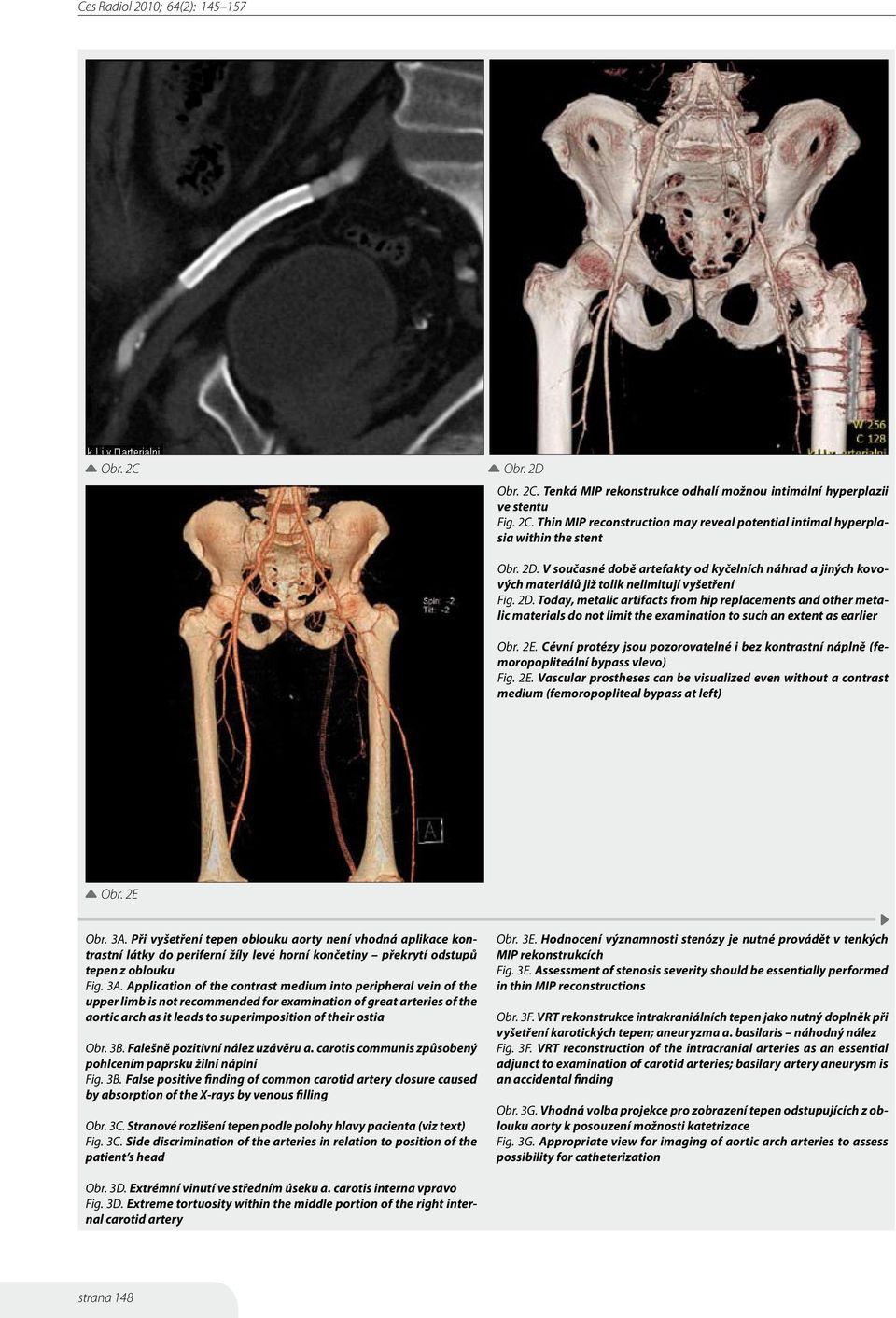 Cévní protézy jsou pozorovatelné i bez kontrastní náplně (femoropopliteální bypass vlevo) Fig. 2E.