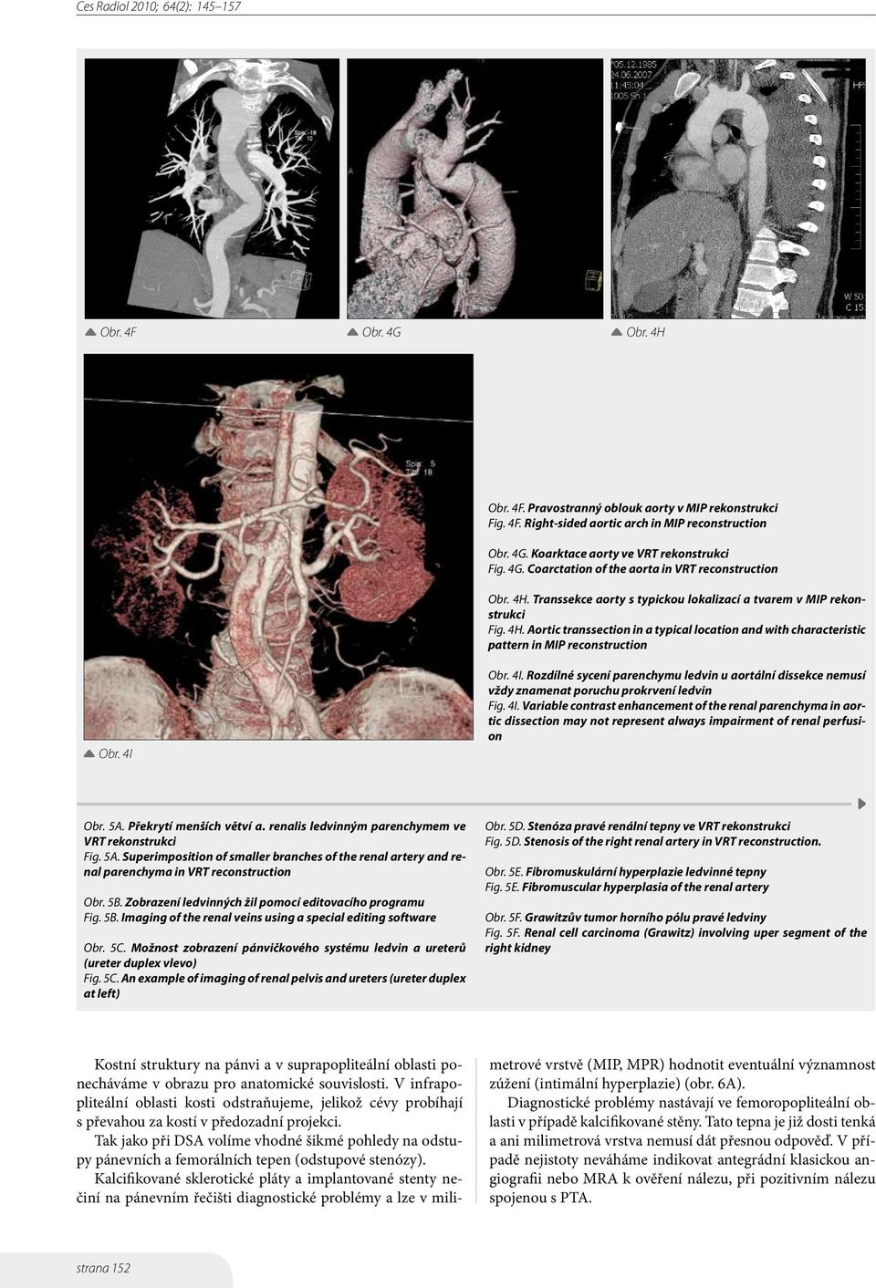 Obr. 4I. Rozdílné sycení parenchymu ledvin u aortální dissekce nemusí vždy znamenat poruchu prokrvení ledvin Fig. 4I. Variable contrast enhancement of the renal parenchyma in aortic dissection may not represent always impairment of renal perfusion Obr.