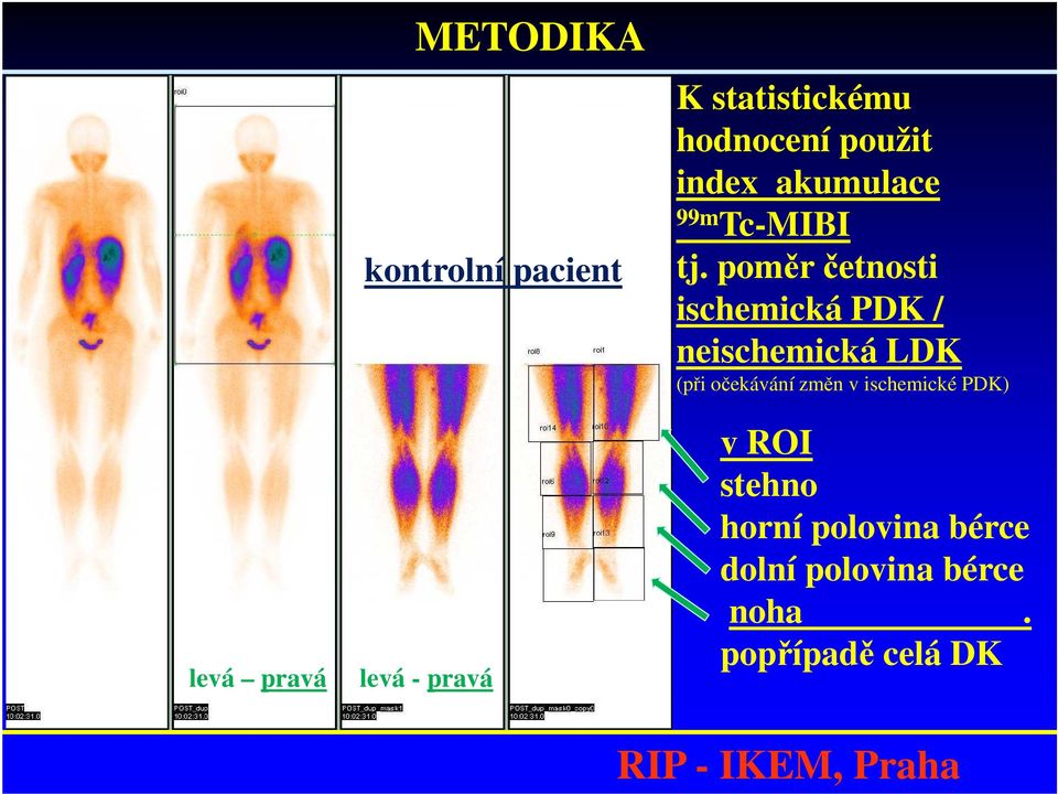 poměr četnosti ischemická PDK / neischemická LDK (při očekávání změn v