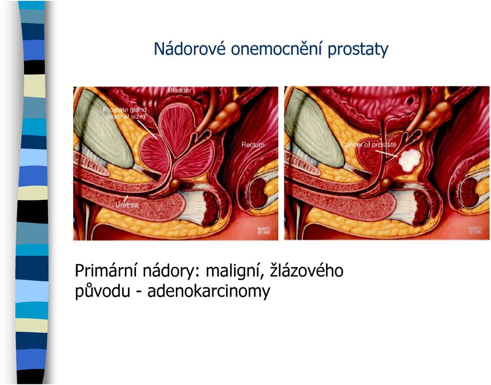 nádory: maligní,