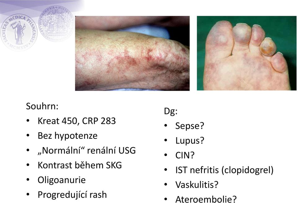 Oligoanurie Progredující rash Dg: Sepse? Lupus?