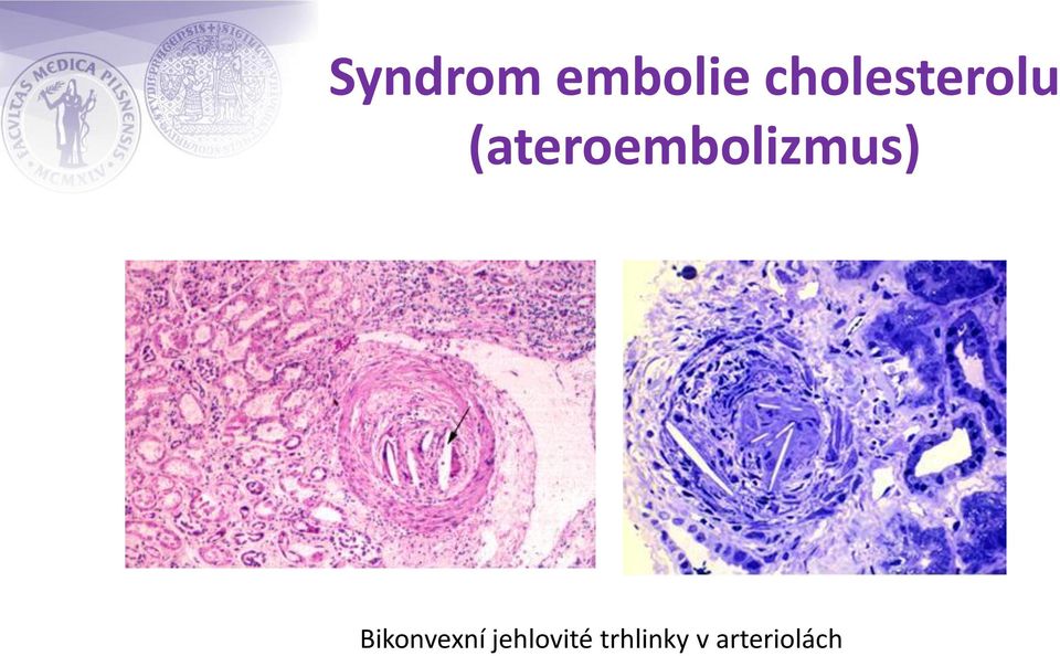 (ateroembolizmus)
