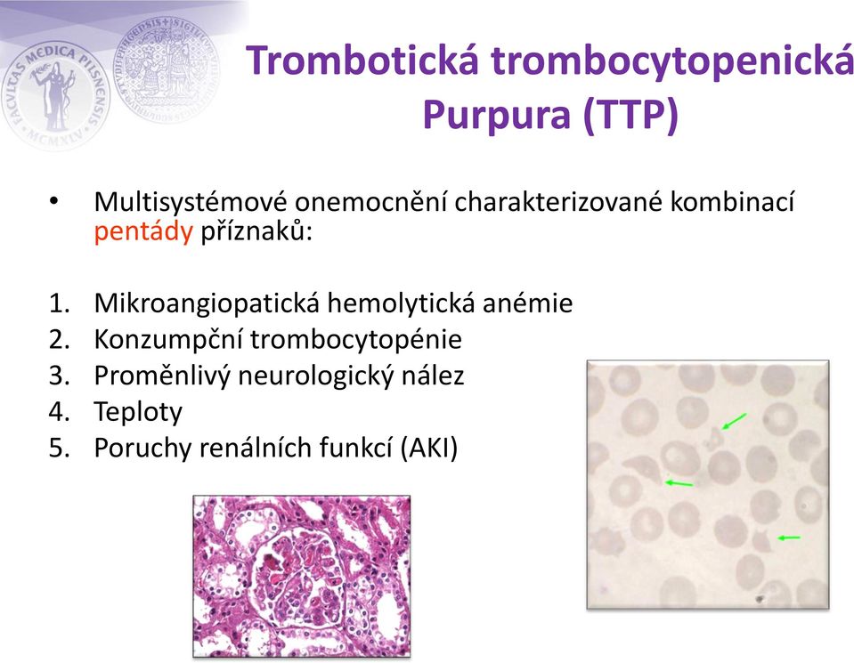 Mikroangiopatická hemolytická anémie 2.