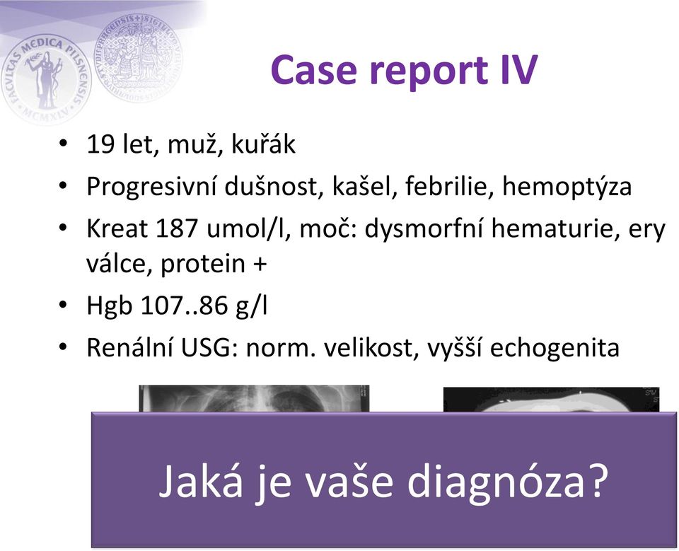 dysmorfní hematurie, ery válce, protein + Hgb 107.