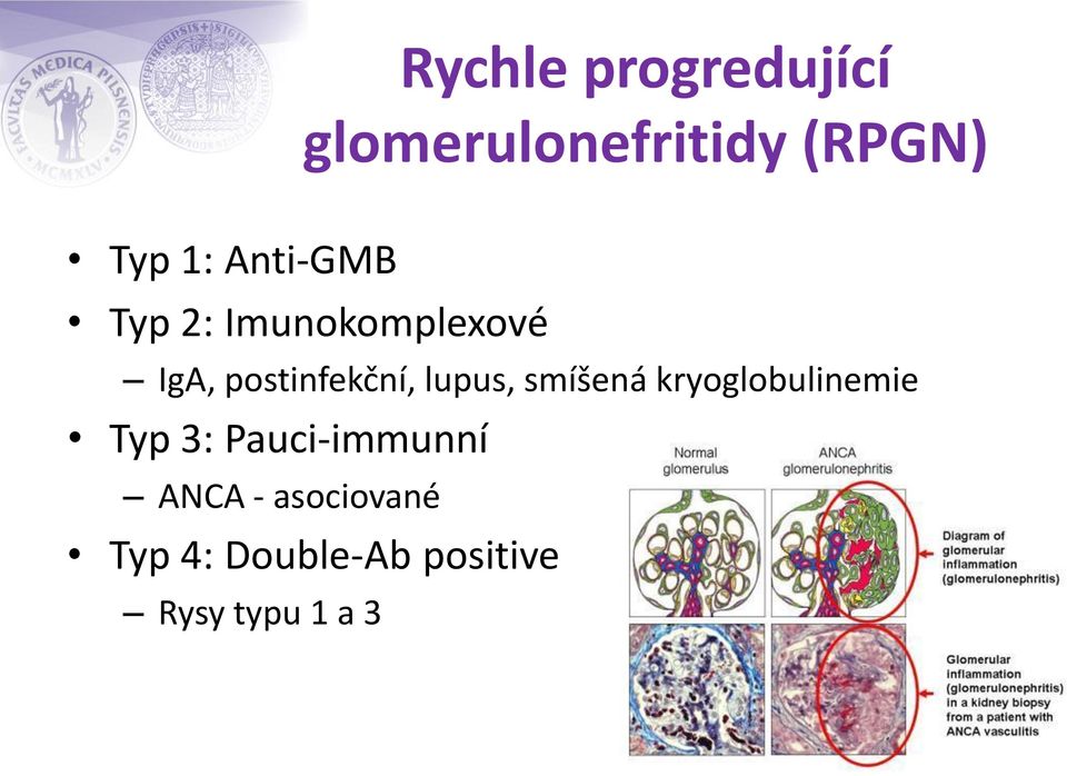 lupus, smíšená kryoglobulinemie Typ 3: Pauci-immunní