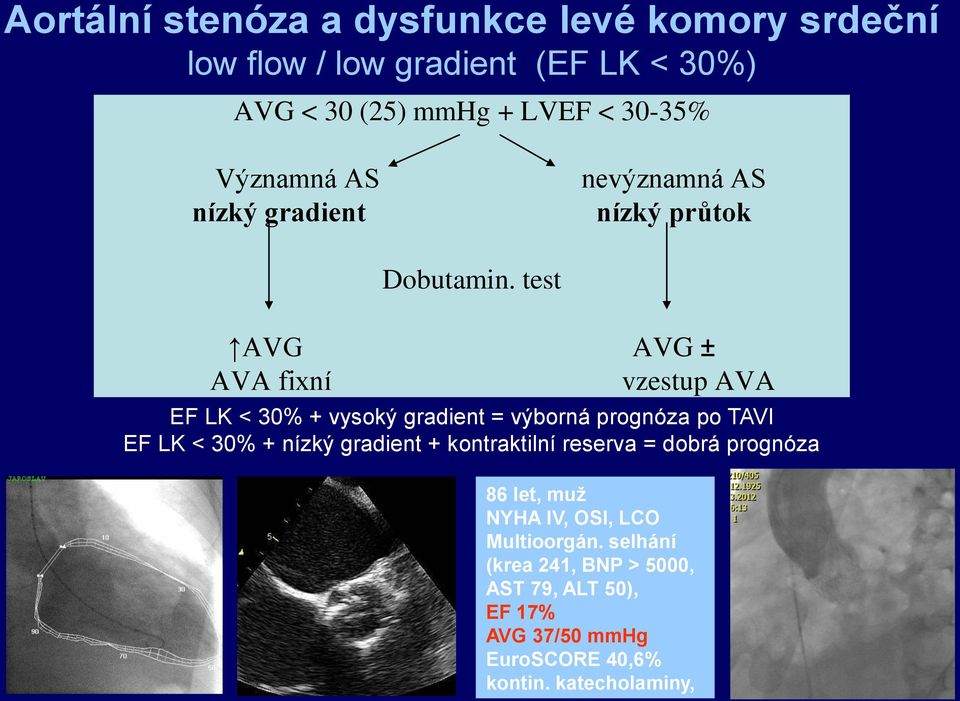 test AVG AVG ± AVA fixní vzestup AVA EF LK < 30% + vysoký gradient = výborná prognóza po TAVI EF LK < 30% + nízký gradient +