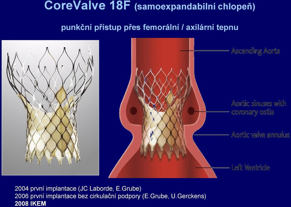 implantace (JC Laborde, E.