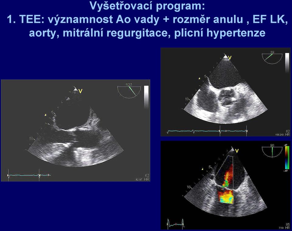 rozměr anulu, EF LK, aorty,