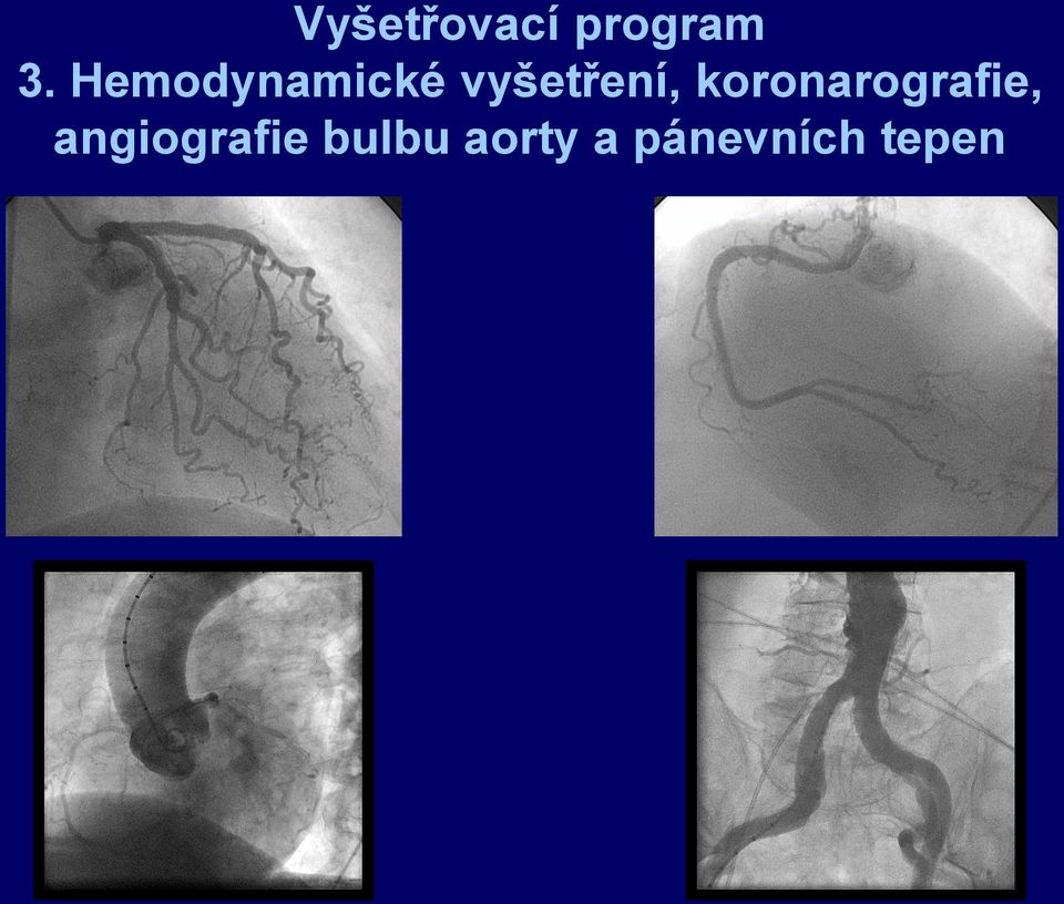 koronarografie,