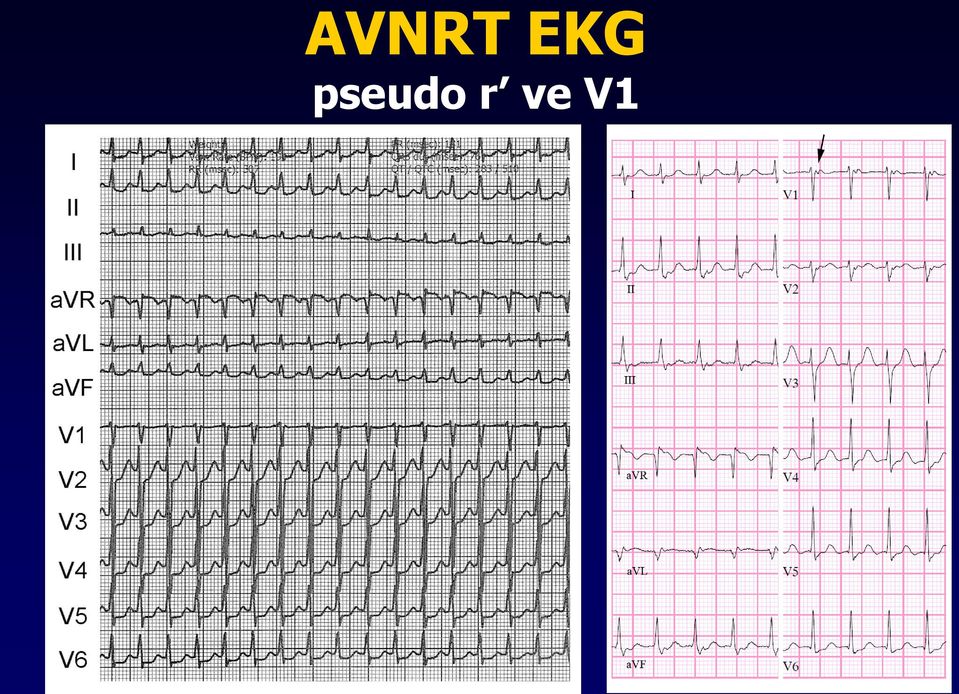 ve V1