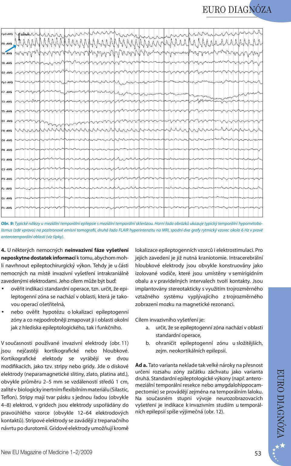pravé anterotemporální oblasti (viz šipky). 4. U některých nemocných neinvazivní fáze vyšetření neposkytne dostatek informací k tomu, abychom mohli navrhnout epileptochirurgický výkon.