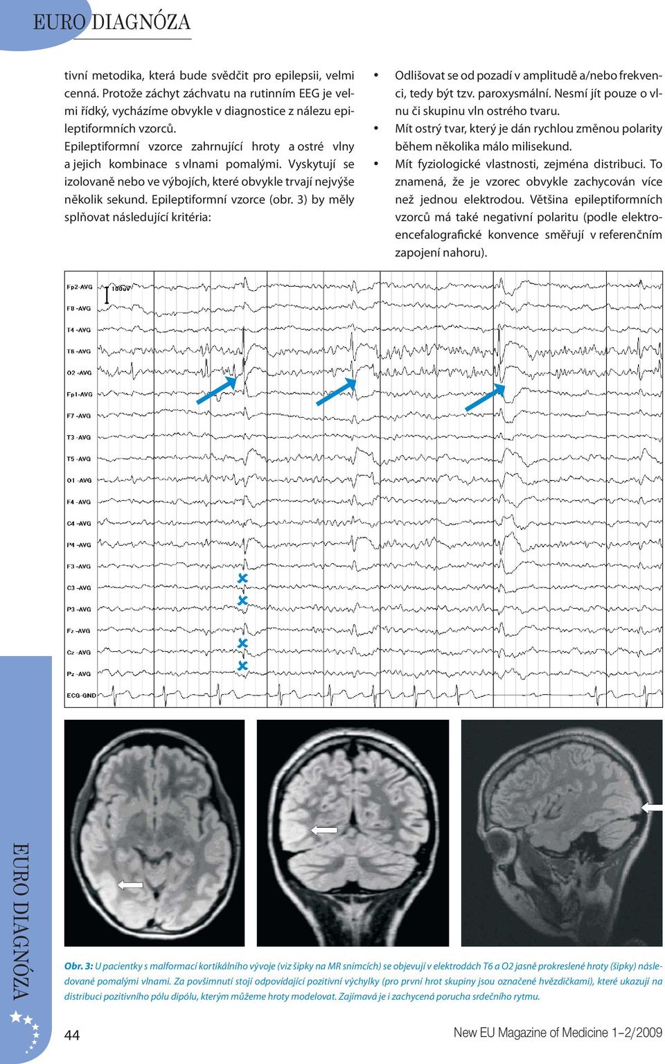 Epileptiformní vzorce (obr. 3) by měly splňovat následující kritéria: Odlišovat se od pozadí v amplitudě a/nebo frekvenci, tedy být tzv. paroxysmální.