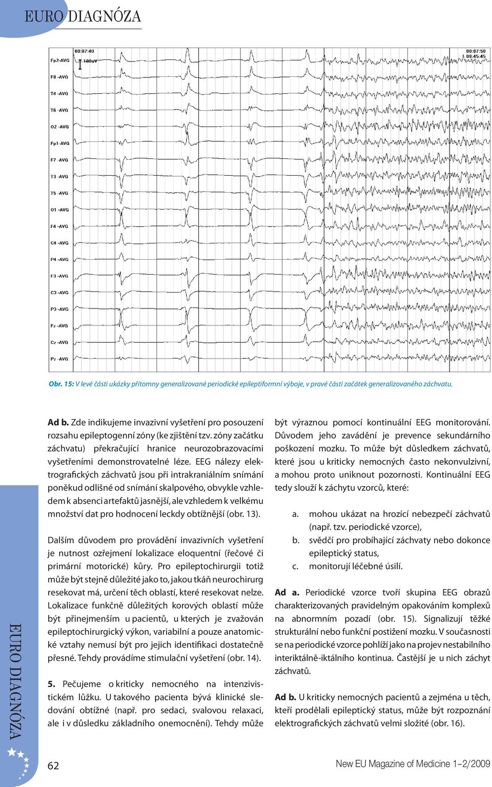 EEG nálezy elektrografických záchvatů jsou při intrakraniálním snímání poněkud odlišné od snímání skalpového, obvykle vzhledem k absenci artefaktů jasnější, ale vzhledem k velkému množství dat pro