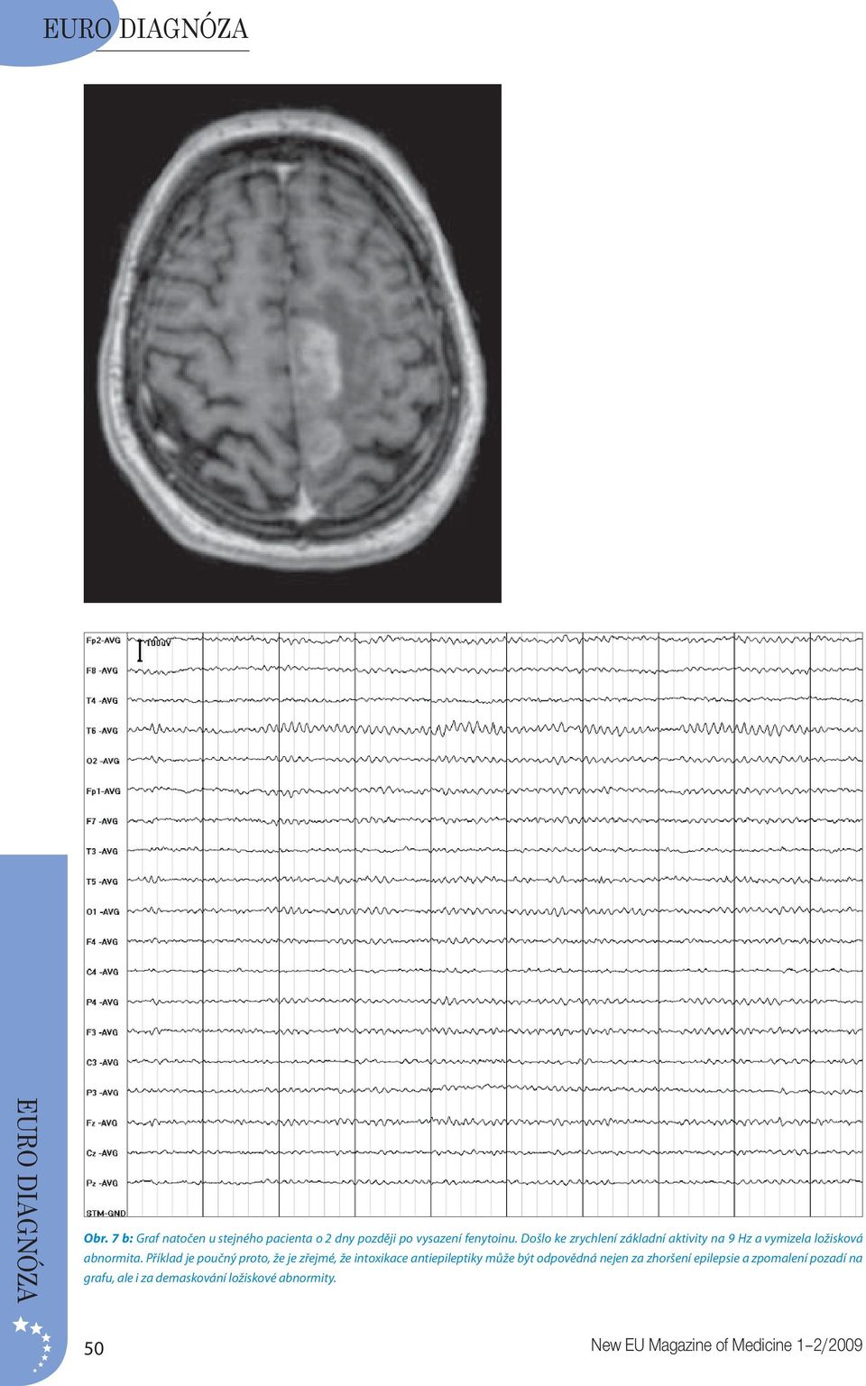 Příklad je poučný proto, že je zřejmé, že intoxikace antiepileptiky může být odpovědná nejen za