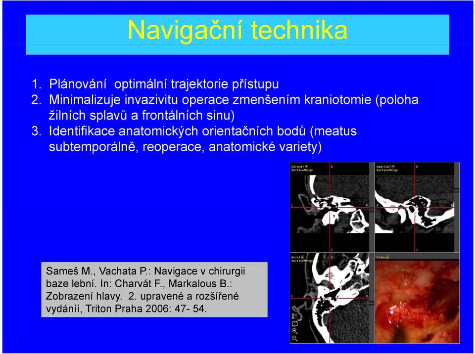 Identifikace anatomických orientačních bodů (meatus subtemporálně, reoperace, anatomické variety) Sameš M.
