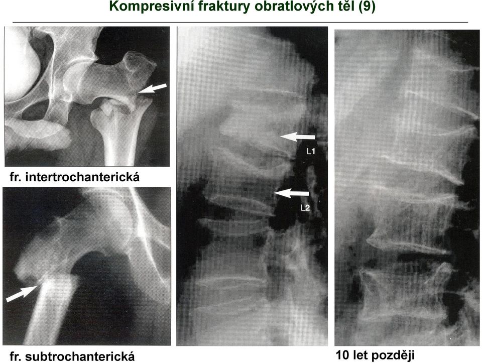 intertrochanterická fr.