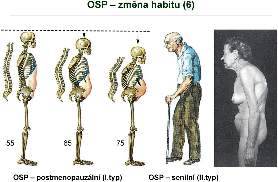 postmenopauzální (I.