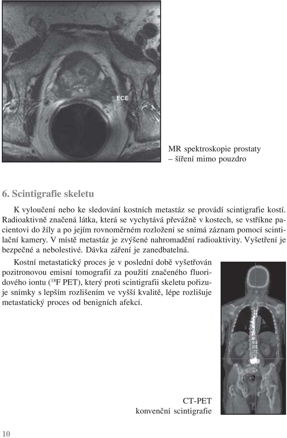 V místě metastáz je zvýšené nahromadění radioaktivity. Vyšetření je bezpečné a nebolestivé. Dávka záření je zanedbatelná.