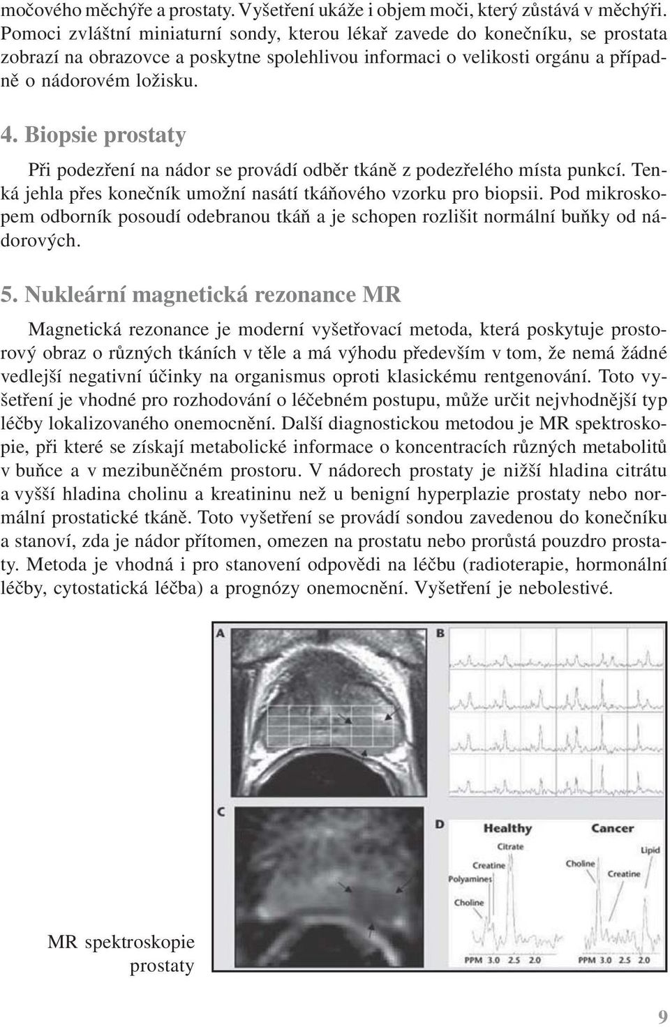 Biopsie prostaty Při podezření na nádor se provádí odběr tkáně z podezřelého místa punkcí. Tenká jehla přes konečník umožní nasátí tkáňového vzorku pro biopsii.