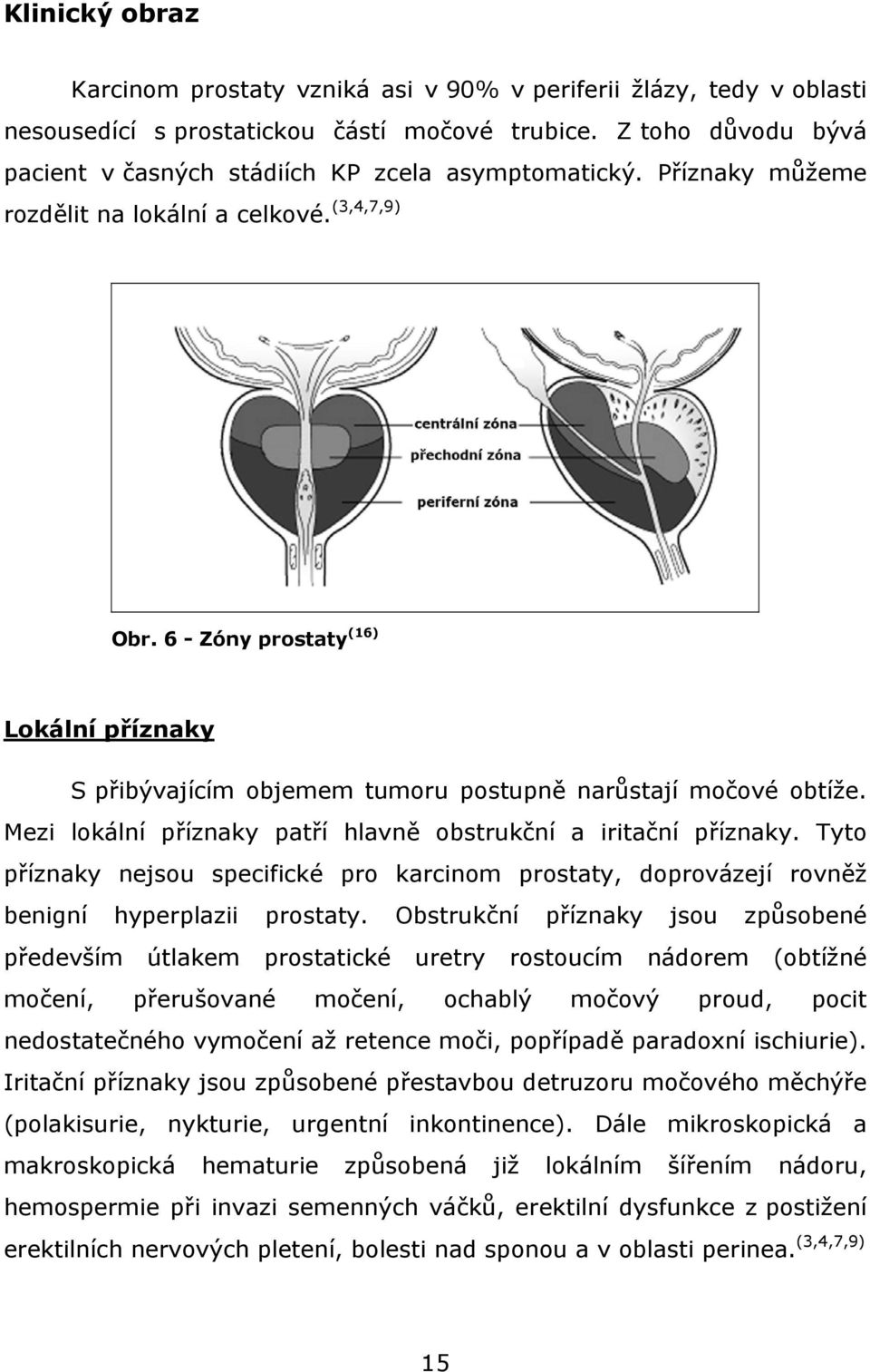 6 - Zóny prostaty (16) Lokální příznaky S přibývajícím objemem tumoru postupně narůstají močové obtíže. Mezi lokální příznaky patří hlavně obstrukční a iritační příznaky.