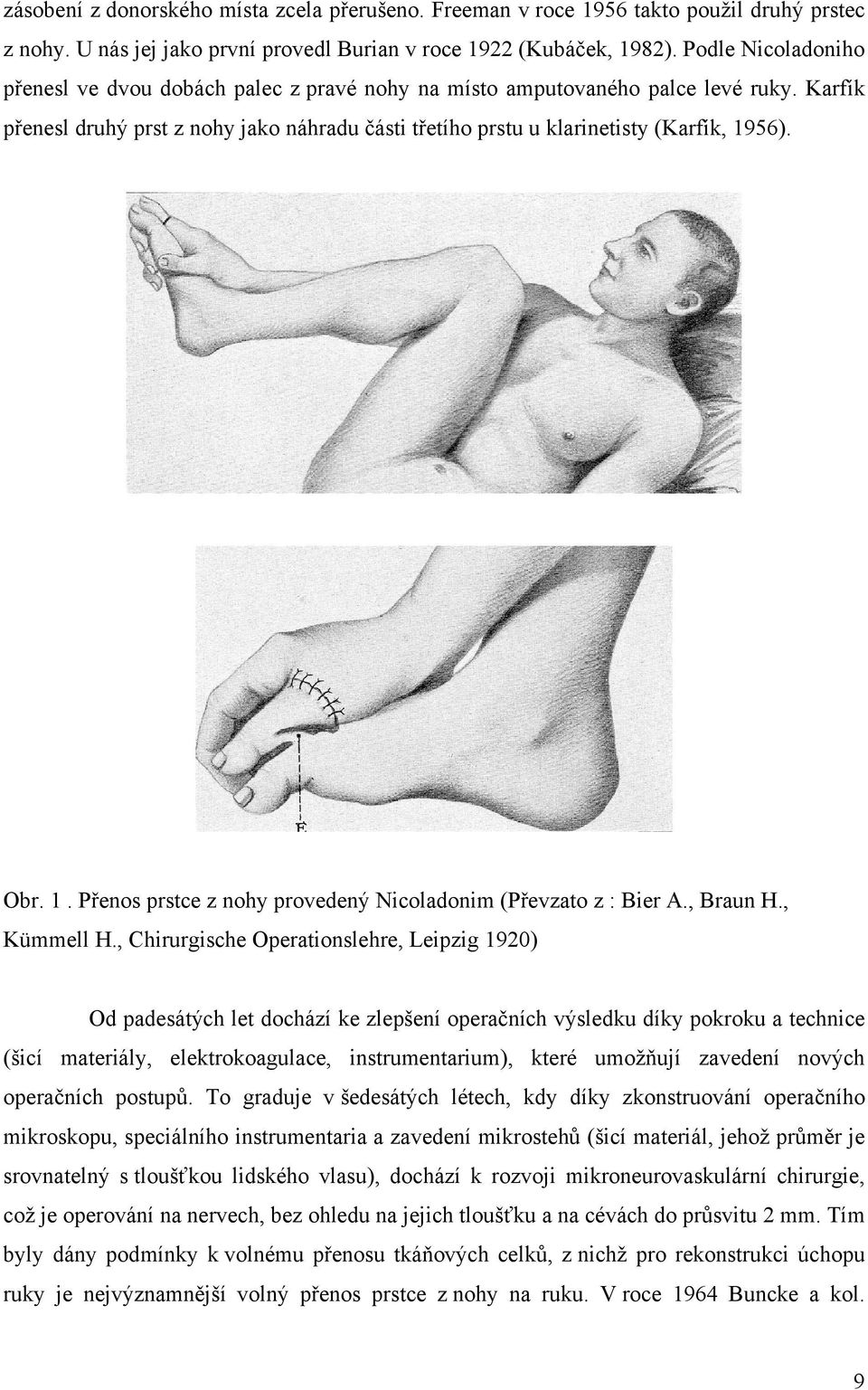 Obr. 1. Přenos prstce z nohy provedený Nicoladonim (Převzato z : Bier A., Braun H., Kümmell H.
