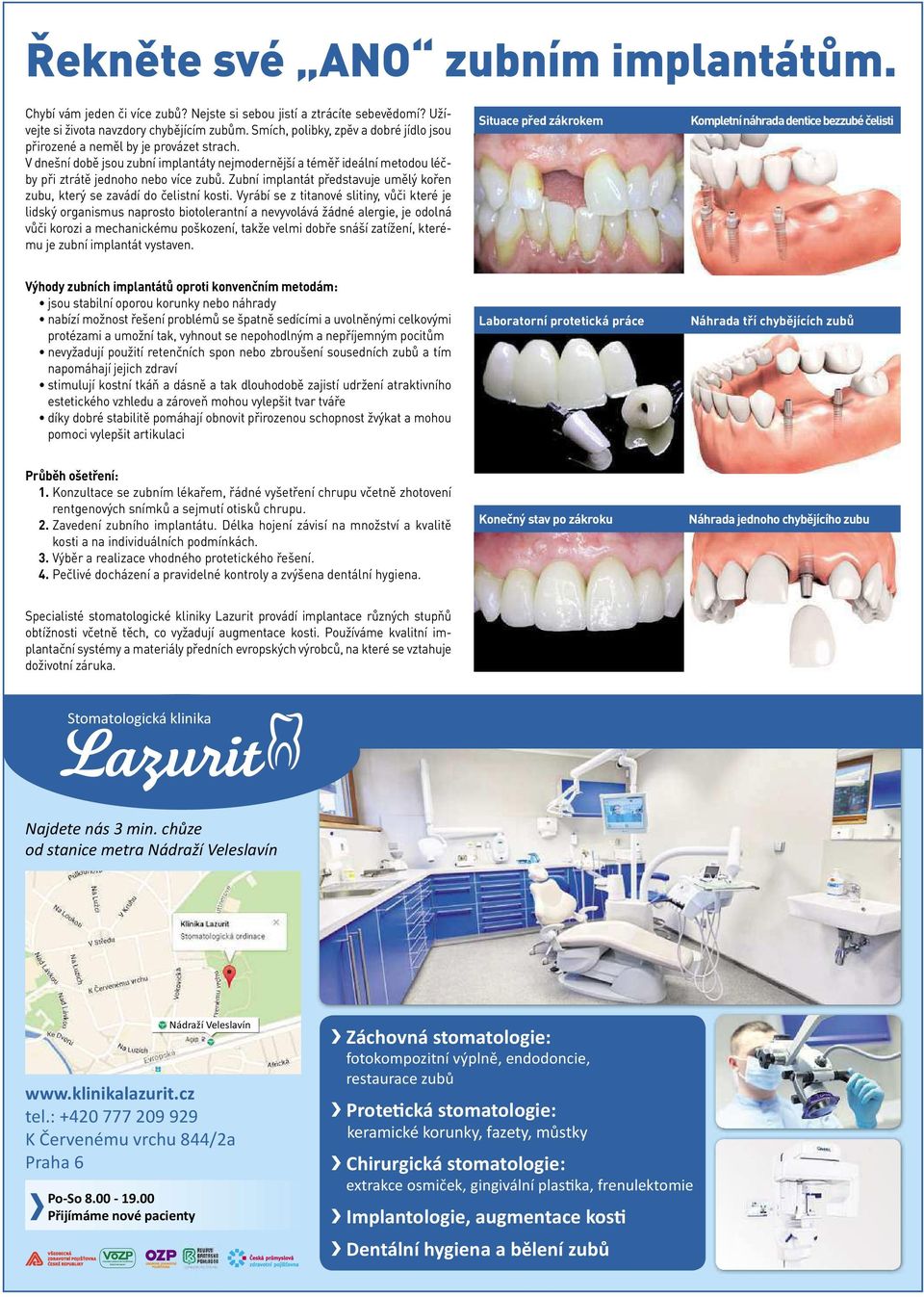 Zubní implantát představuje umělý kořen zubu, který se zavádí do čelistní kosti.