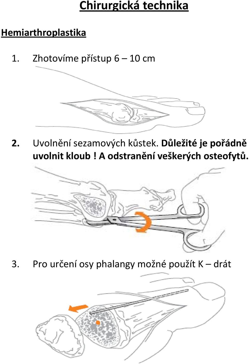 Uvolnění sezamových kůstek.