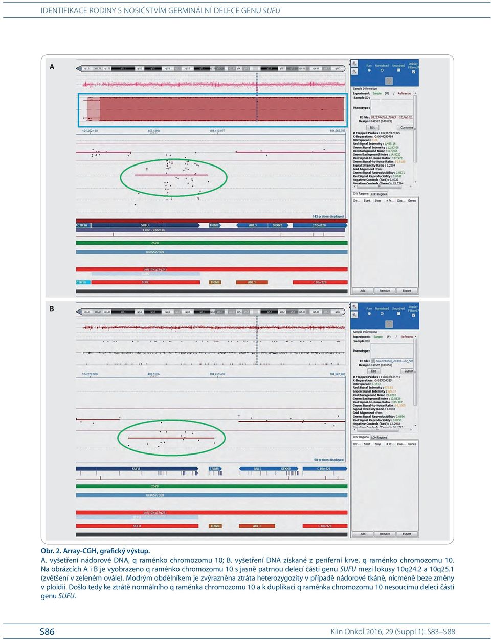 Na obrázcích A i B je vyobrazeno q raménko chromozomu 10 s jasně patrnou delecí části genu SUFU mezi lokusy 10q24.2 a 10q25.