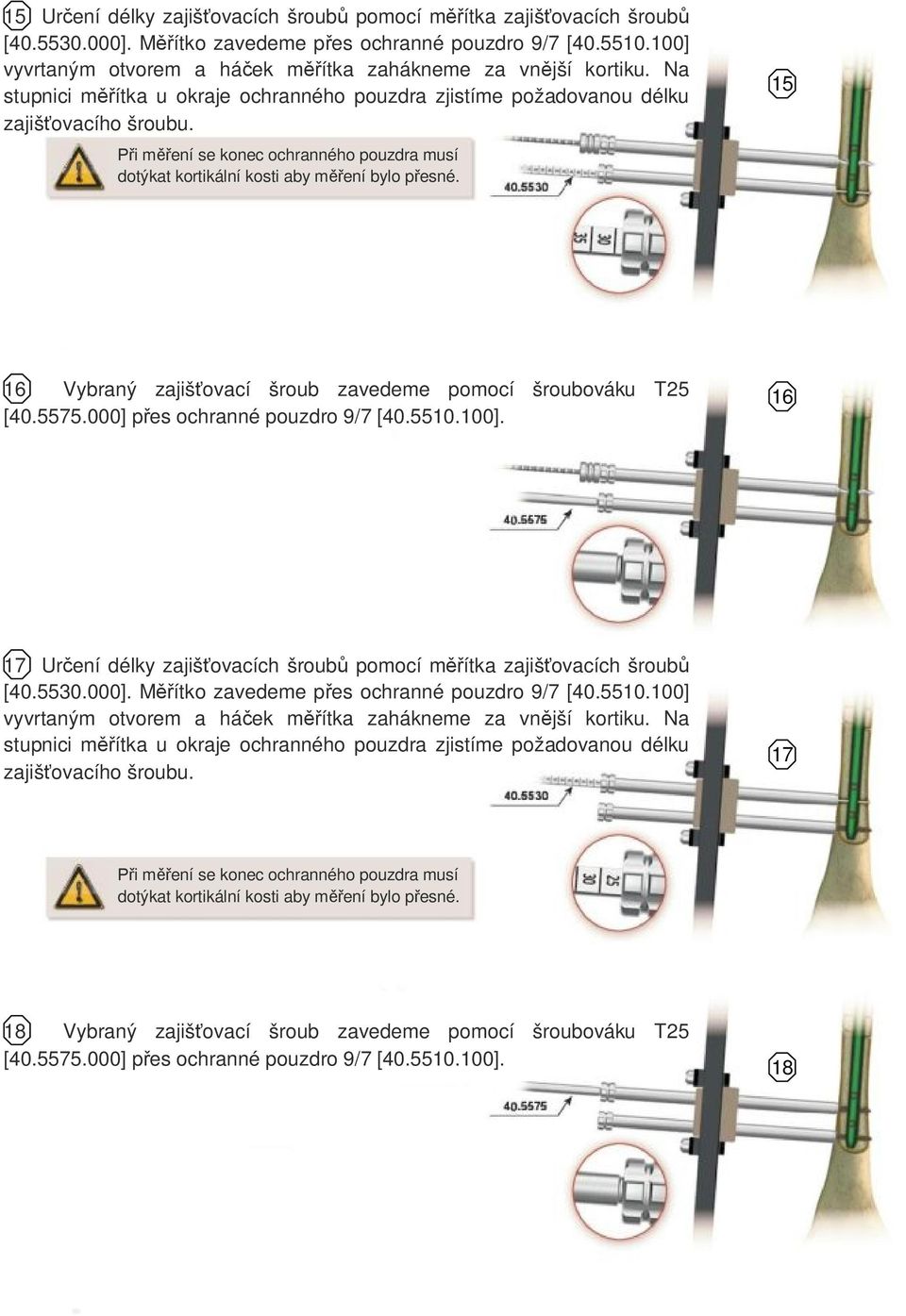 Při měření se konec ochranného pouzdra musí dotýkat kortikální kosti aby měření bylo přesné. 15 16 Vybraný zajišťovací šroub zavedeme pomocí šroubováku T25 [40.5575.000] přes ochranné pouzdro 9/7 [40.