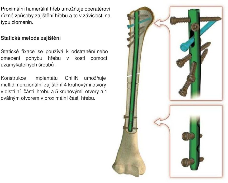 Statická metoda zajištění Statické fixace se používá k odstranění nebo omezení pohybu hřebu v kosti