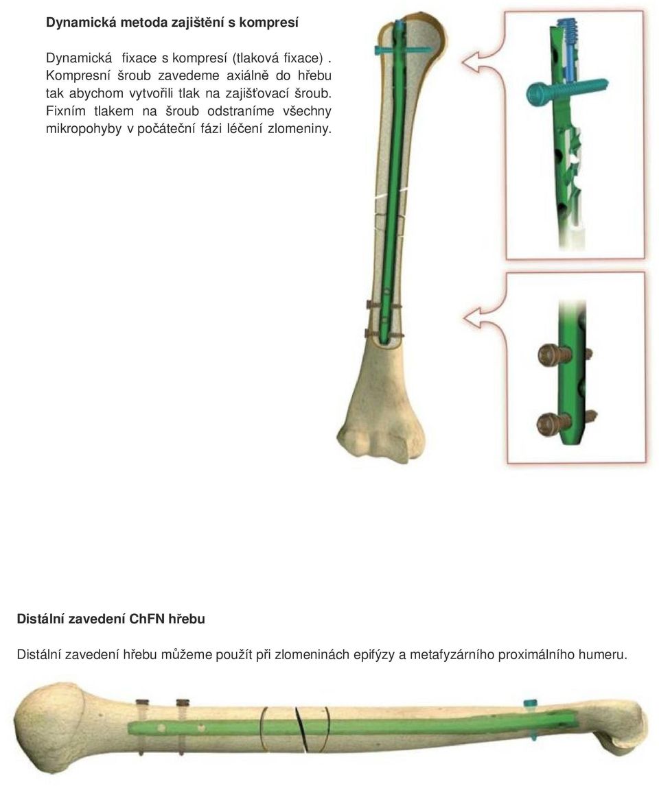 Fixním tlakem na šroub odstraníme všechny mikropohyby v počáteční fázi léčení zlomeniny.