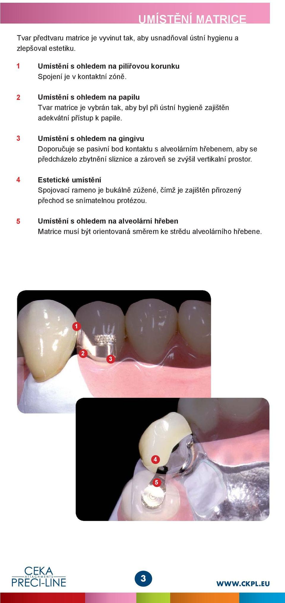 Umístění s ohledem na papilu Tvar matrice je vybrán tak, aby byl při ústní hygieně zajištěn adekvátní přístup k papile.