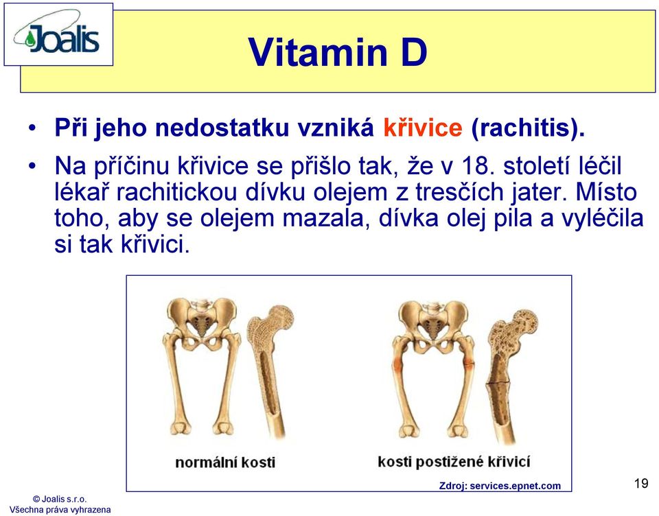 století léčil lékař rachitickou dívku olejem z tresčích jater.