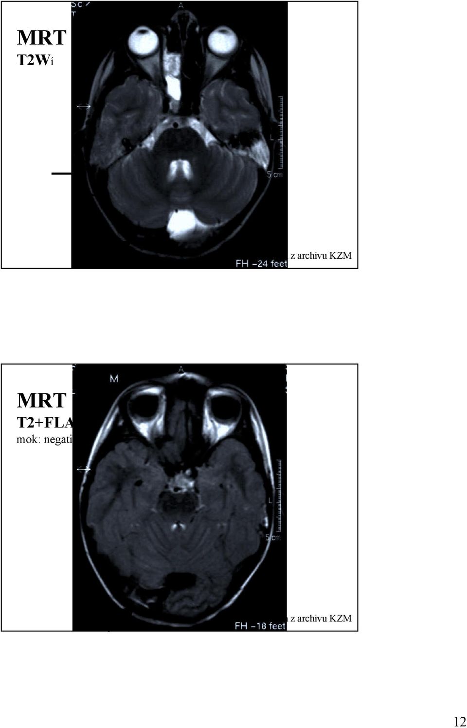 T2+FLAIR mok: negativní