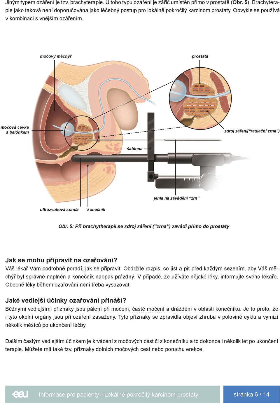 močový měchýř prostata močová cévka s balónkem zdroj záření( radiační zrna ) šablona jehla na zavádění zrn ultrazvuková sonda konečník Obr.
