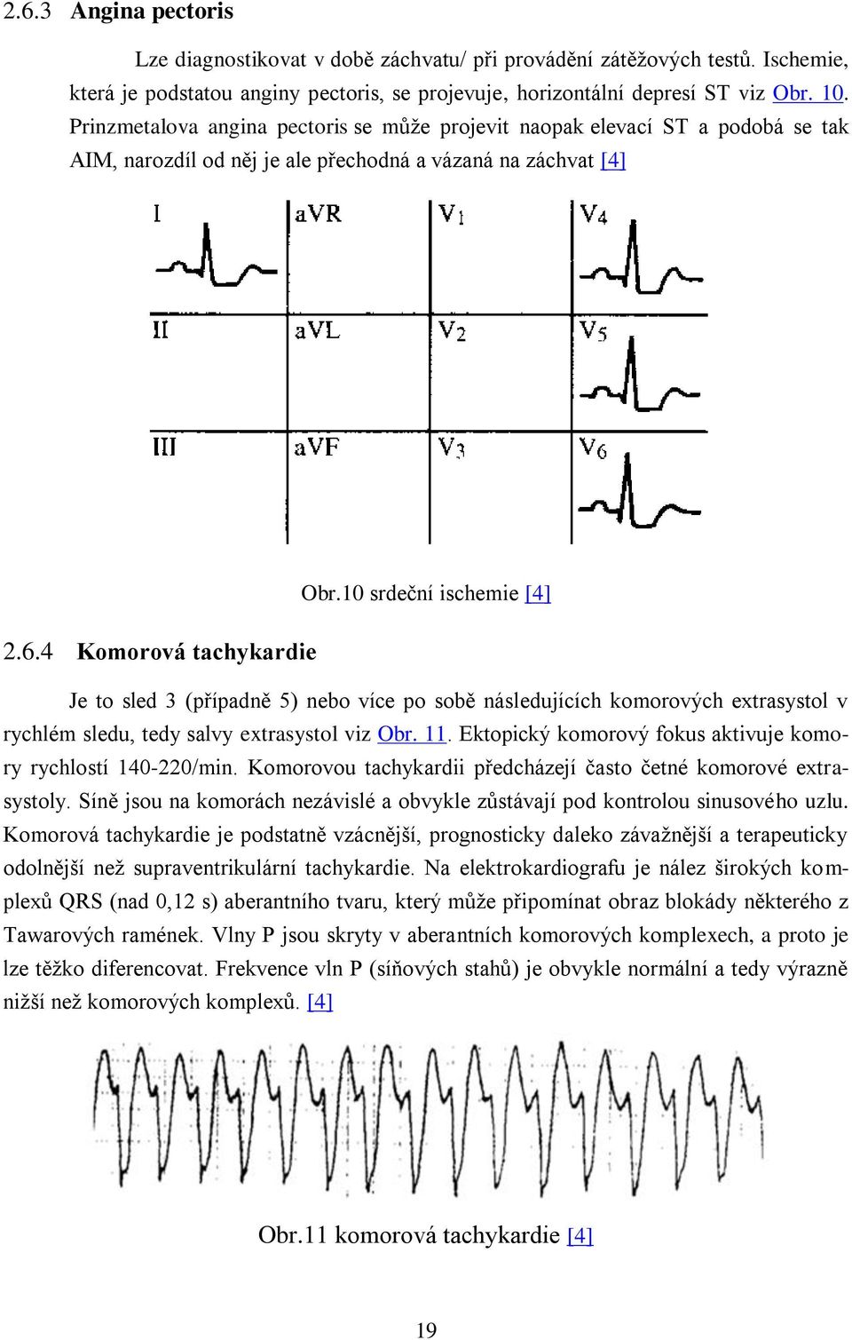 4 Komorová tachykardie Je to sled 3 (případně 5) nebo více po sobě následujících komorových extrasystol v rychlém sledu, tedy salvy extrasystol viz Obr. 11.