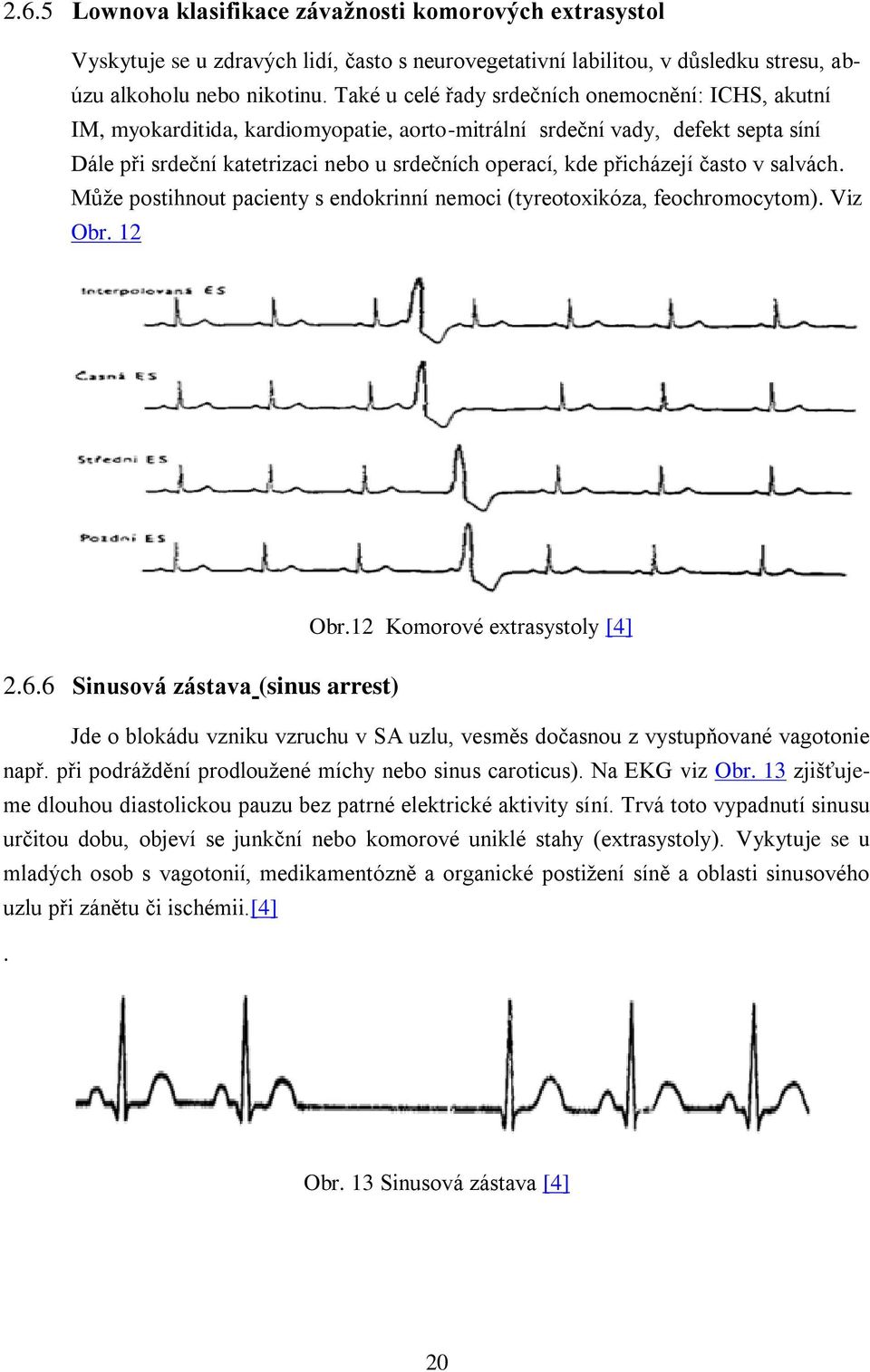 přicházejí často v salvách. Může postihnout pacienty s endokrinní nemoci (tyreotoxikóza, feochromocytom). Viz Obr. 12 Obr.12 Komorové extrasystoly [4] 2.6.