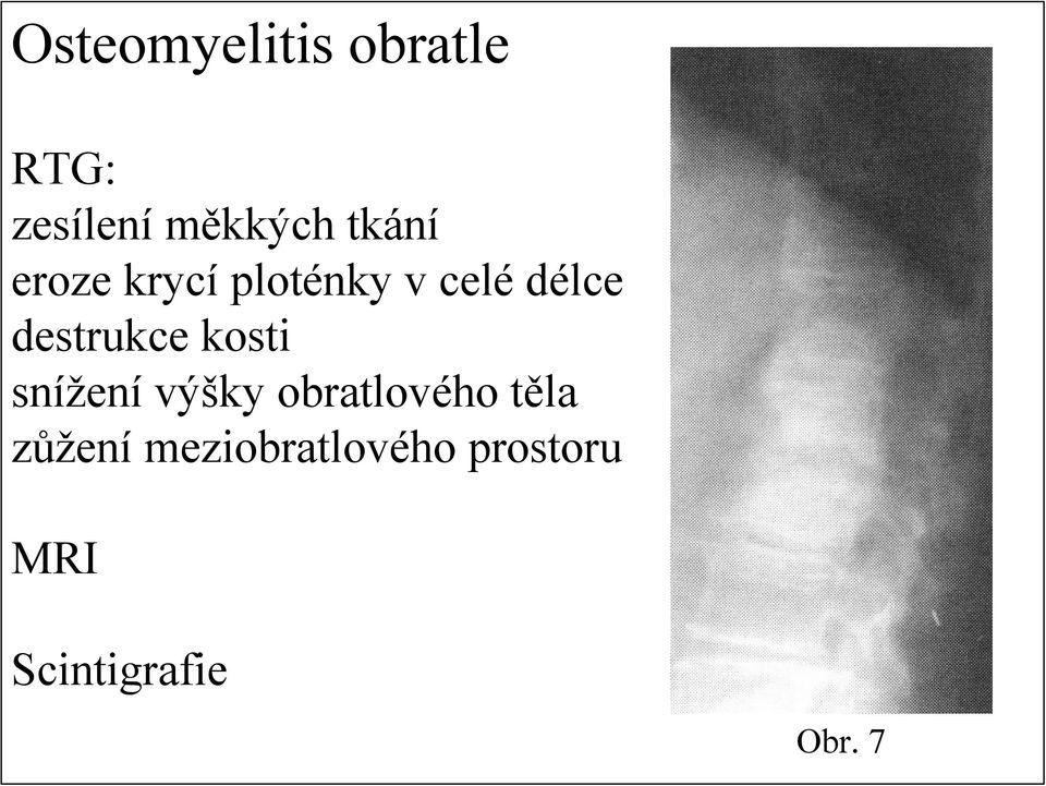 destrukce kosti snížení výšky obratlového těla