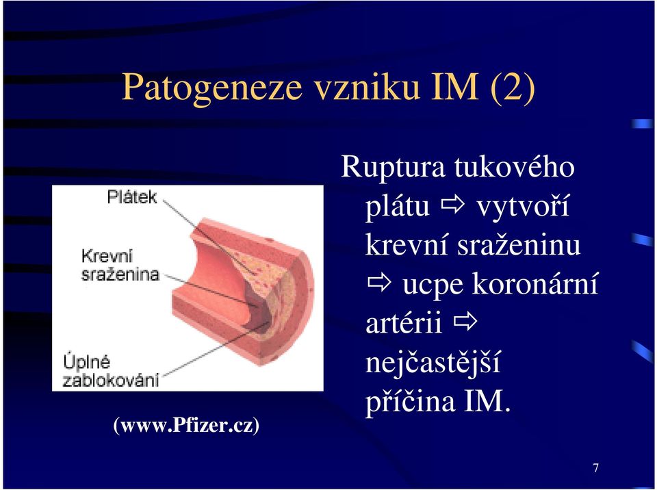 cz) Ruptura tukového plátu vytvoří