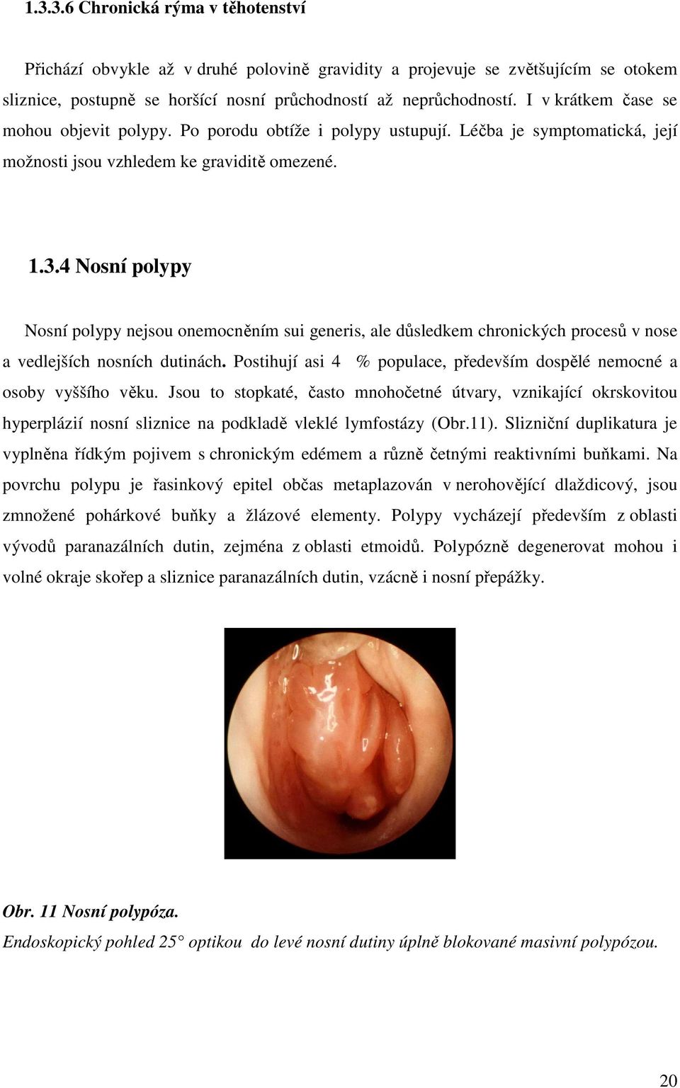 4 Nosní polypy Nosní polypy nejsou onemocněním sui generis, ale důsledkem chronických procesů v nose a vedlejších nosních dutinách.