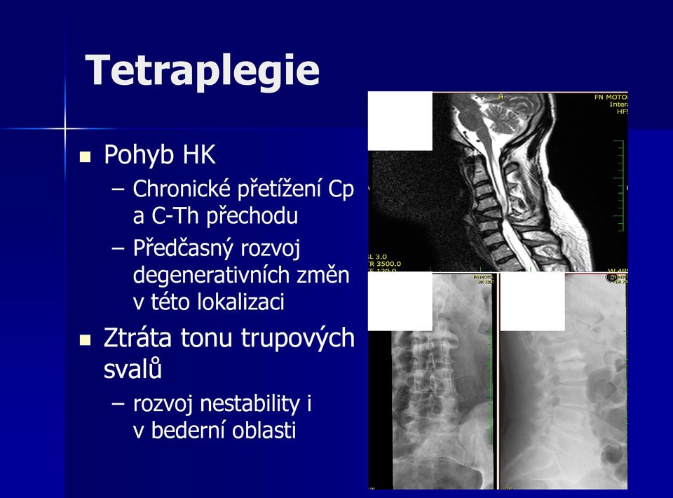 degenerativních změn v této lokalizaci Ztráta