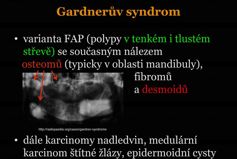 fibromů a desmoidů http://radiopaedia.