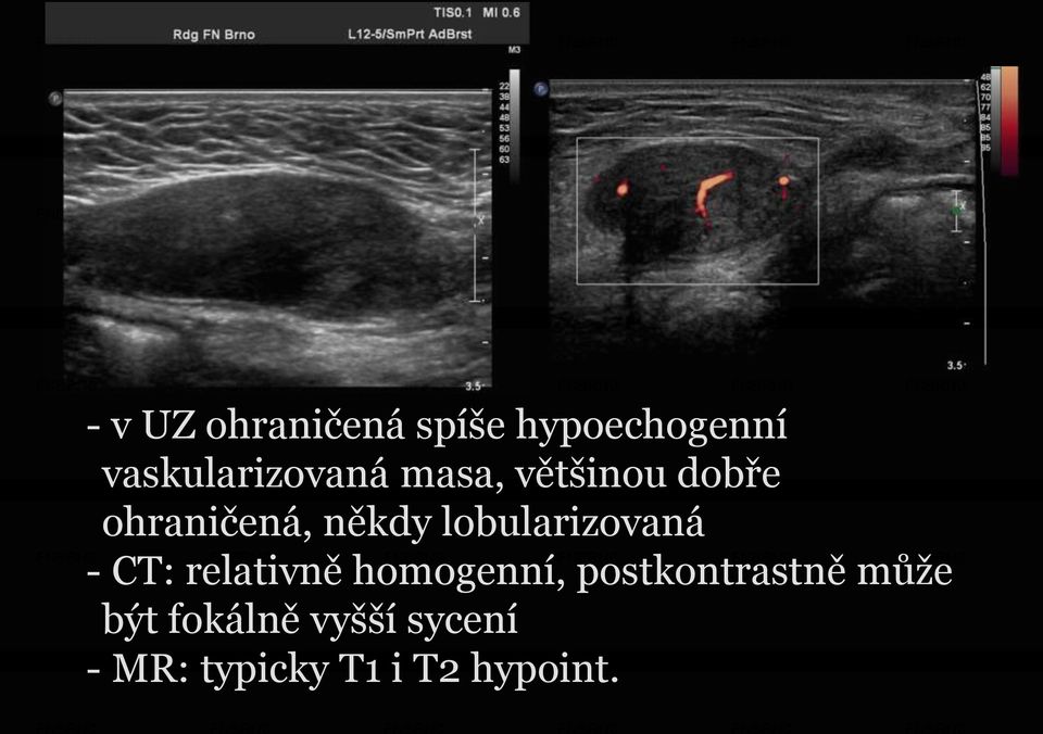 někdy lobularizovaná - CT: relativně homogenní,